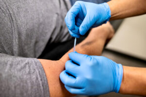 Needling acupuncture in forearm